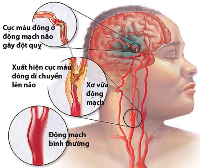 Đột quỵ có thể cướp đi mạng sống bất cứ lúc nào